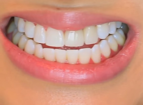 A fogfehérítést és a fogkőleszedést is bízhatjuk dentálhigiénikusra