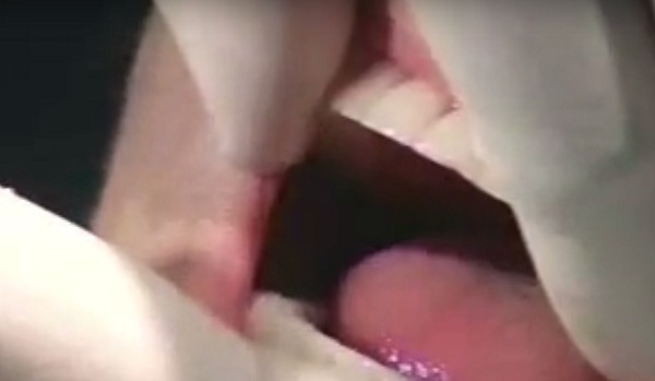 A mini implantátum fixen megtartja a fogsort