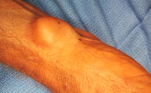 Púp a kézfejen – A ganglion egynapos sebészeti műtétje