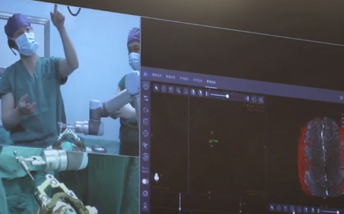 Mesterséges intelligencia – 200 km-ről végeztek agyműtétet robottal Kínában
