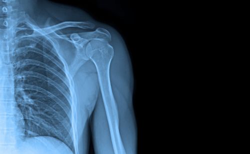 Mesterséges intelligencia azonosíthatja a töréseket a röntgenfelvételeken