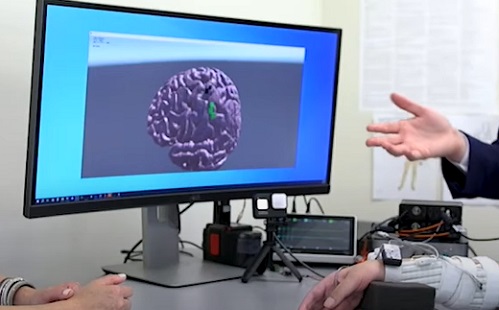 Quadriplegia - Érzést és mozgást állított helyre a mesterséges intelligencia