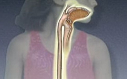 Nyelőcső- és bélprobléma oldható meg a mesterséges intelligencia útján 