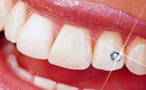 Egyedi mosoly - Mit kell tudni a fogékszerről?