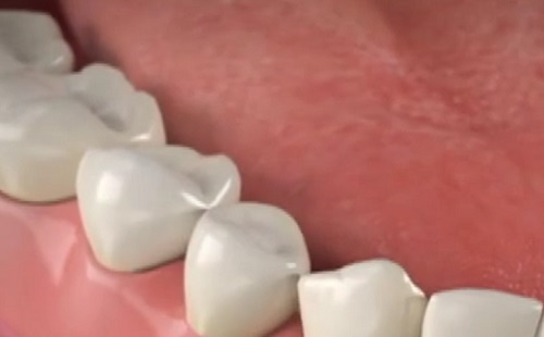 Tartályból adagol gyógyszert az új fogimplantátum
