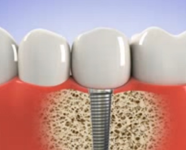 A kutatók speciális bevonattal segítenék a fogimplantátum beilleszkedését