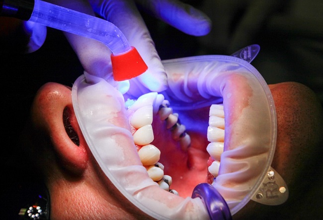 A kutatók védő bevonattal látják el a fogimplantátumokat, hogy ne legyen velük gond