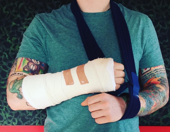 Ed Sheeran megsérült egy bickilibalesetben