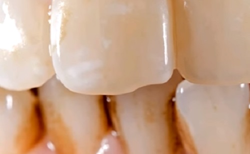 Romboló folyamatot indít el a fogkő