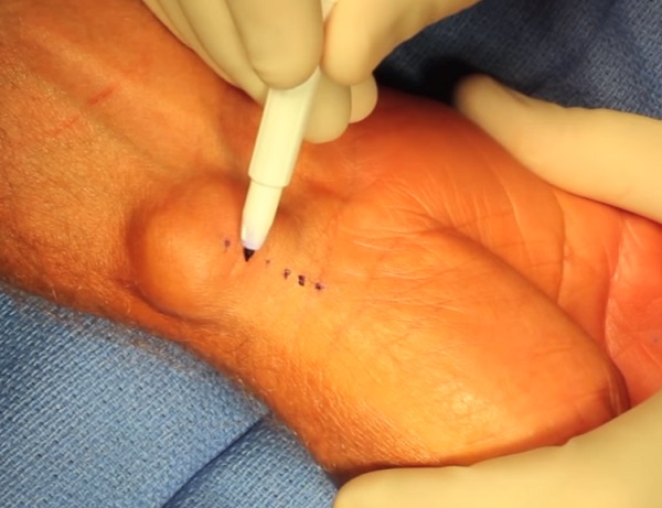 A ganglion egynapos sebészeti műtéttel eltávolítható