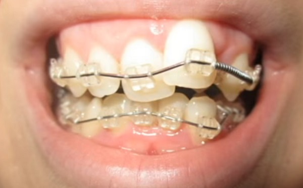 Torlódás, egyenetlen fogsor esetén érdemes fogszabályzót viselni