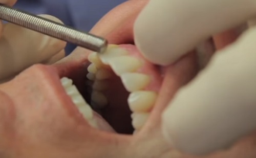 Hogyan kezeljük a foghúzás utáni fogfájást? - HáziPatika