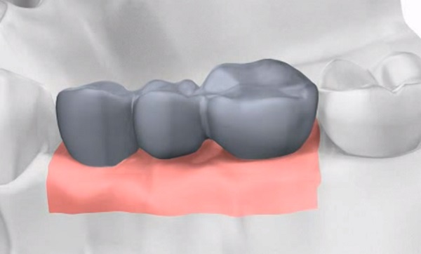 A fogimplantátum megfelelő illeszkedéséhez a csontok állapota is igen fontos