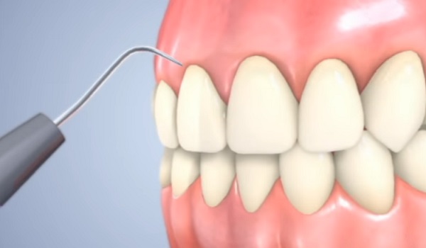 A fogak sajátkezű lekaparászása is használható megoldás - speciális eszközzel