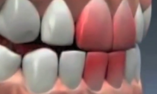A fogcsikorgatás nemcsak a fogakra nagyon káros - a teljes egészségre nézve is