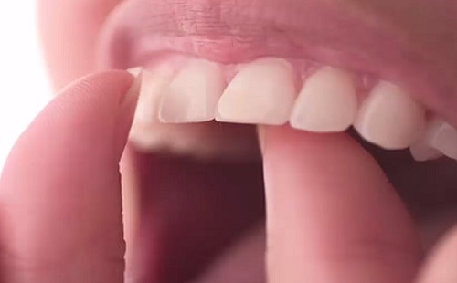 Visszanőhetnek a károsodott fogak egy Alzheimer-gyógyszerrel?