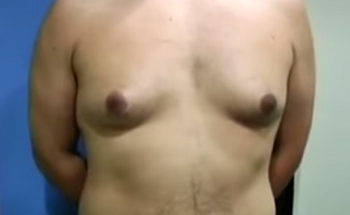 Gynecomastia: hogyan végzik a műtétet?