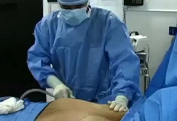 A gynecomastia műtét során eltávolítják a felesleges zsírszövetet