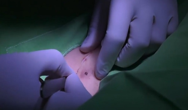 Bőrrák: a mesterséges intelligencia pontos diagnózisaival több műtét is feleslegessé válhat