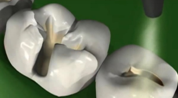 A sealant védő bevonatot képez a fogakon, s távolmaradnak a baktériumok