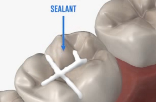 Így készül a sealant - már 6 éves kortól alkalmazható