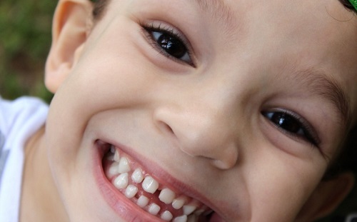 „Halott” fogakhoz vezethetnek a gyerekkori esések
