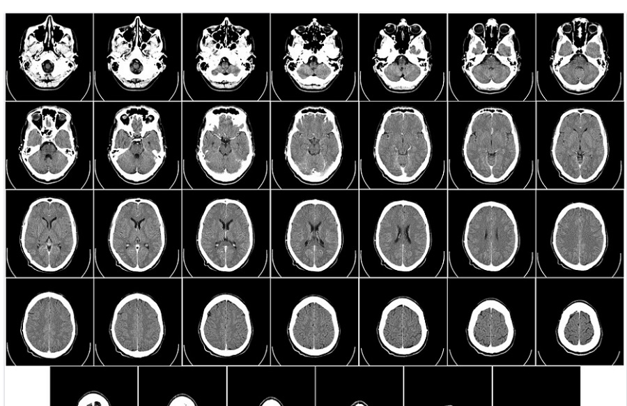 Az agytumor kezelésére is alkalmas lehet hamarosan a mesterséges intelligencia