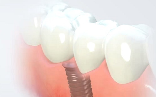 Kerülhet fogászati implantátum egyetlen fog helyére?