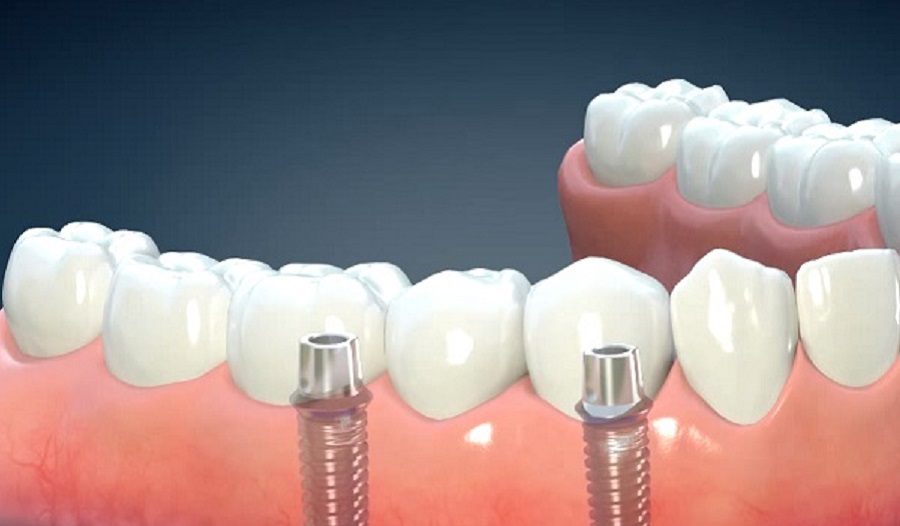 A fogimplantátum ma a legjobb megoldás a természetes fogat követően