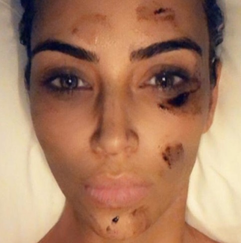 Kim Kardashian West bőrbetegsége