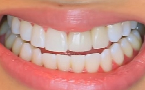 Lézeres kezelés a fogászatban – mi mindenre jó?