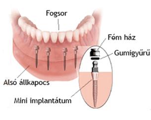 Fixfogsor® Protézisrögzítés