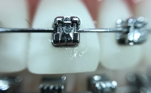 Az ortodontikus kezelés sem garantálja a fogászati egészséget?