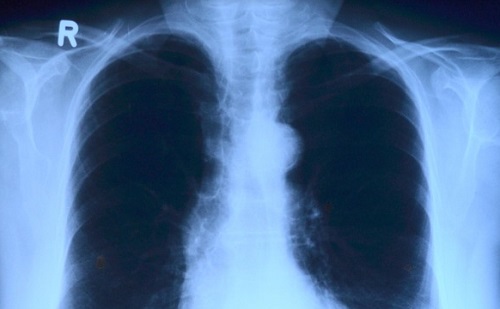 Segíthet az MI a röntgen gyors feldolgozásában