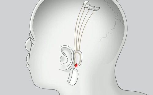 Íme az agyhoz kapcsolódó mesterséges intelligencia eszköz