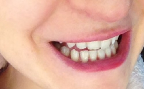 A fogak természetes gyógyulását is támogathatja a fogfehérítő?