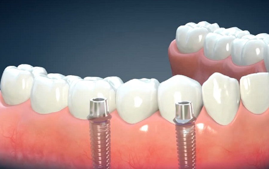 A fogászati technológiák megújulásával az implantátum-készítés is könnyebbé válik