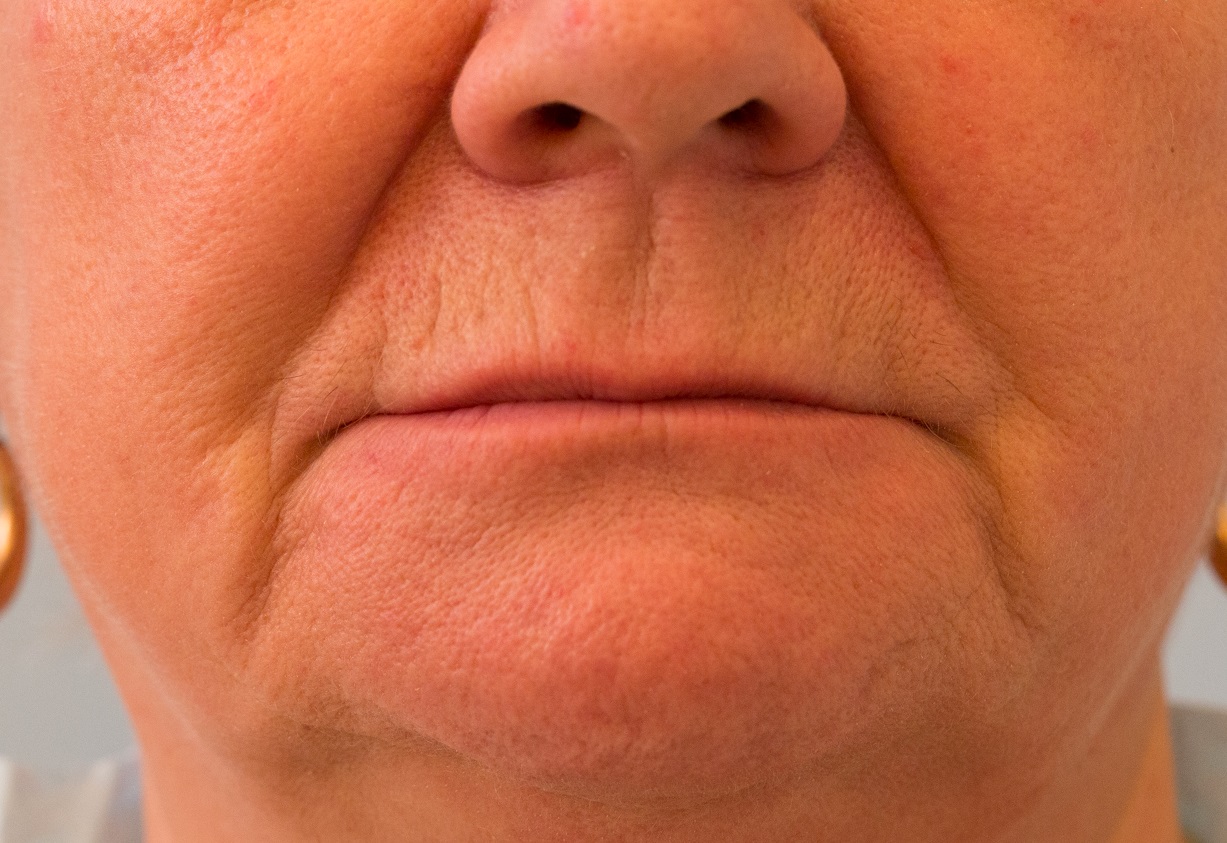 Páciens száj fogpótlás nélkül a tipikus 