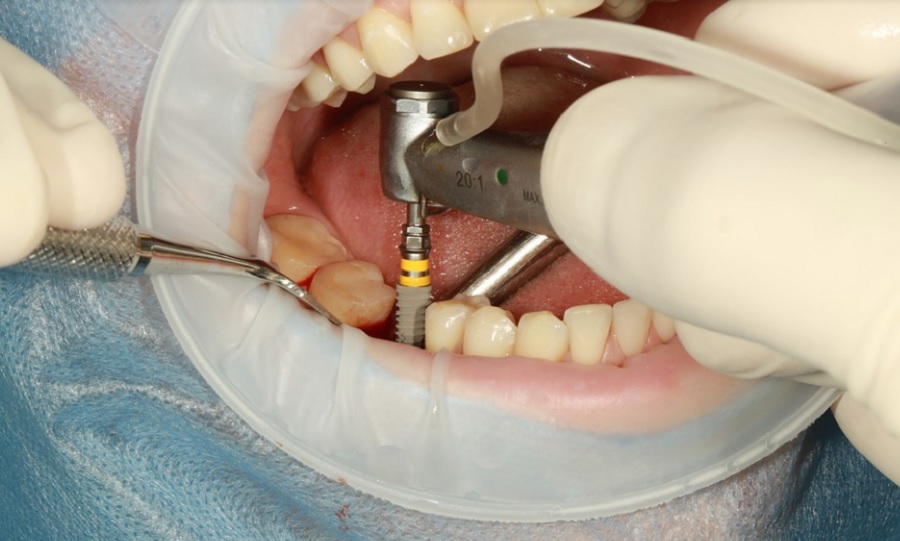 dentalis_implantacio_1