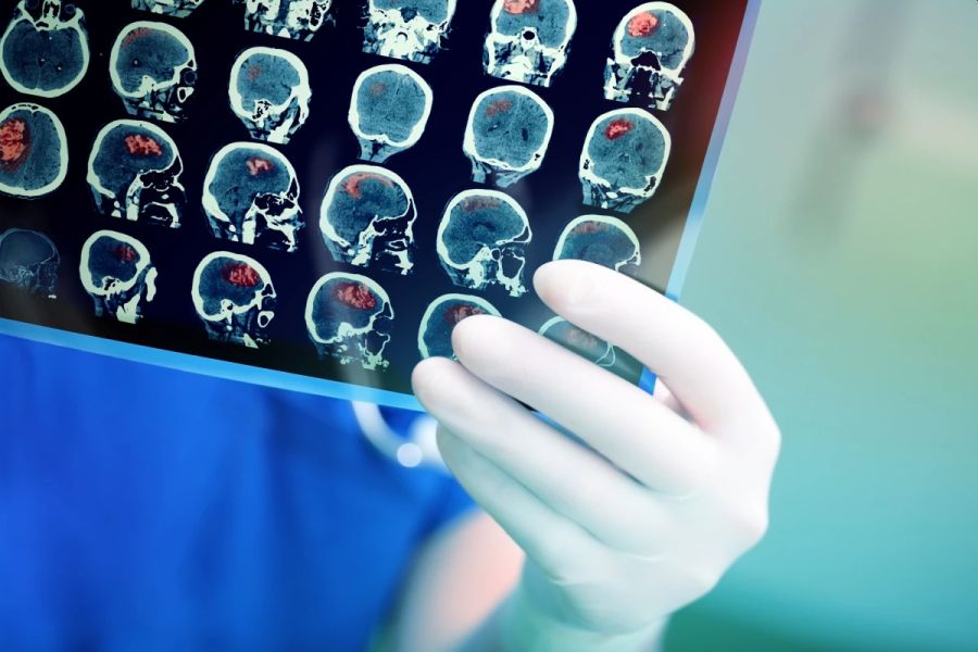 Az orvosok munkáját támogatja az agyi sérülések felkutatásában a mesterséges intelligencia