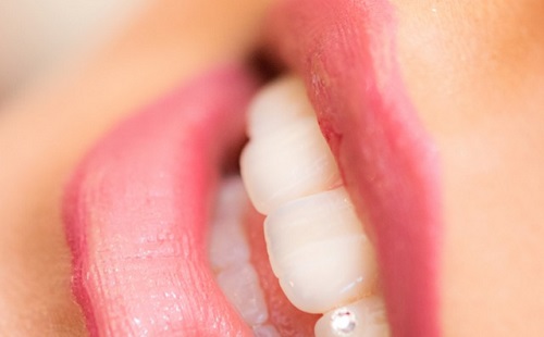 Új úton a fogimplantátum-hidak fejlesztése