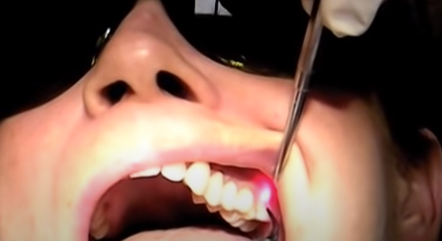 Az ínybetegség kezelendő, mielőtt fogimplantátumot készíttetünk