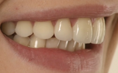 Mennyire fájdalmas a fogimplantátum? 