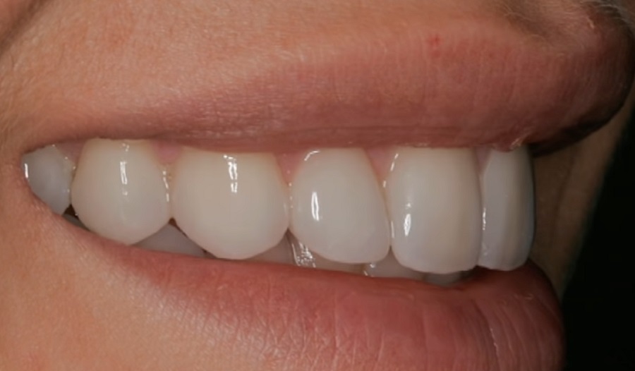 A fogimplantátum-kezelés során is van mód átmeneti fogak behelyezésére