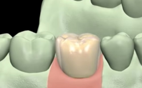 A fogimplantátum a stresszre is érzékeny lehet