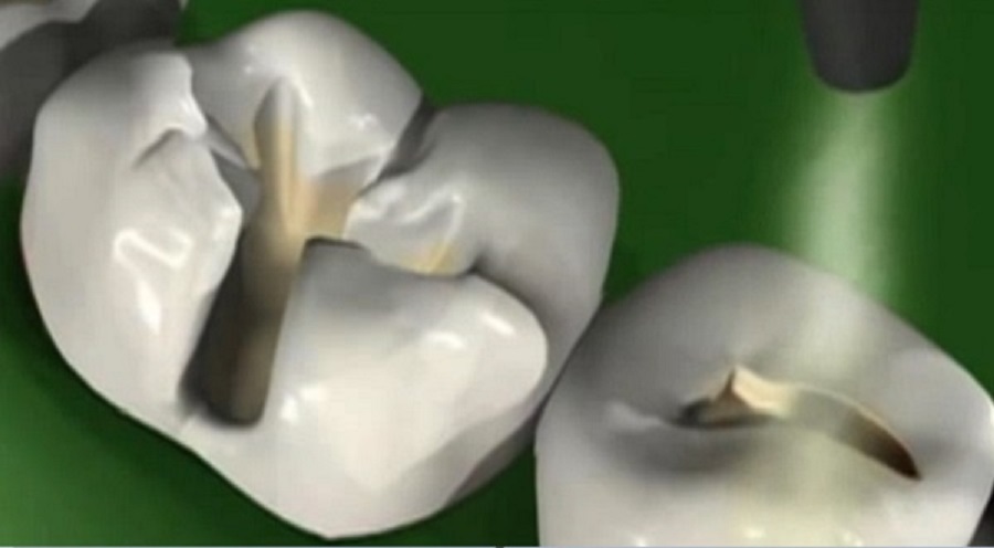 Az elhalt fogat mindenképp kezeltetni kell - komoly fertőzést is okozhat