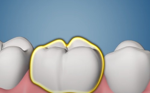 Így fest a fogászati implantátum-tervezés jövője