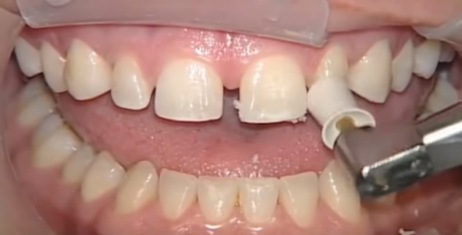 A fogak közötti rést ma már helyre lehet hozni