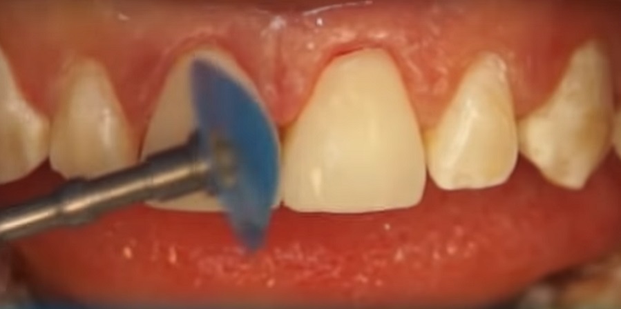 A fogak közti rés kezelésére több lehetőség is van