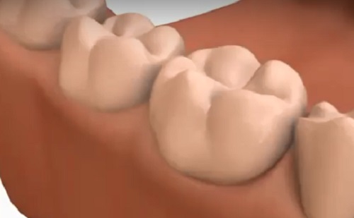 A fogakon képződő biofilm szerepet játszhat a fertőzésekben